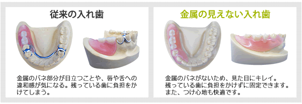 金属の見えない入れ歯(義歯)ノンクラスプデンチャー
