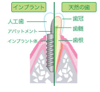 インプラント