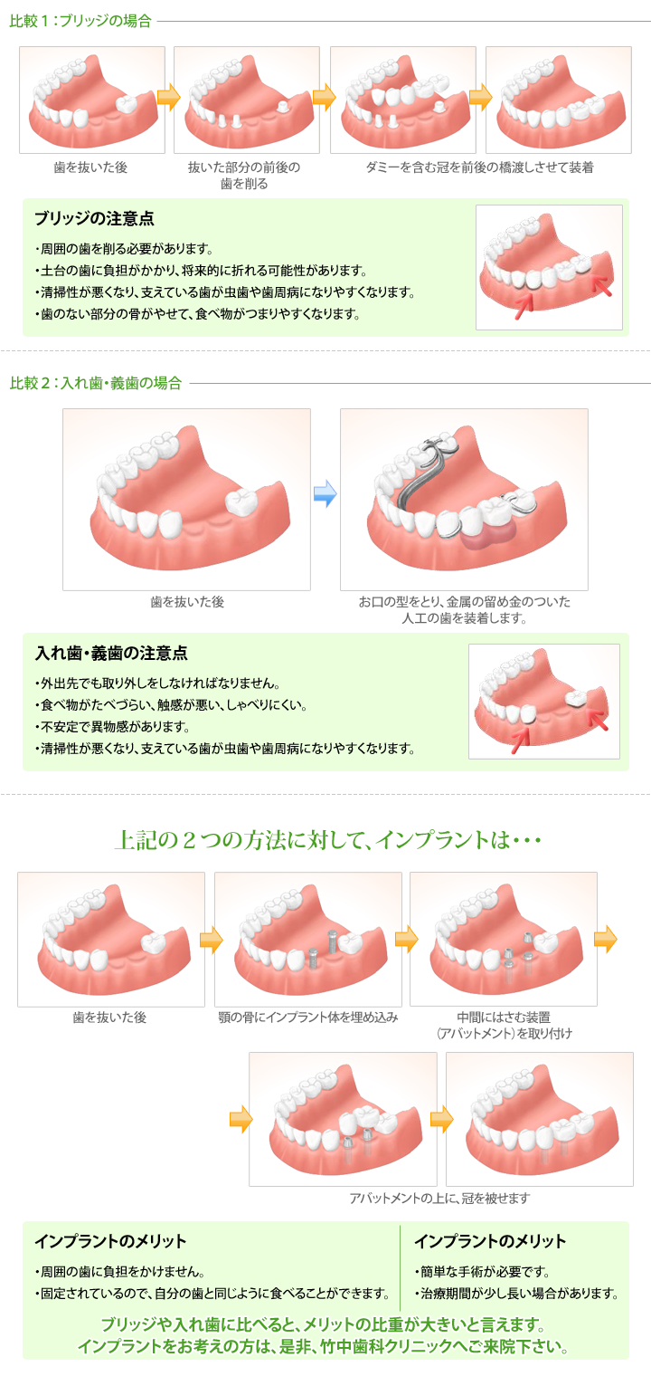 インプラントと他の治療法との比較