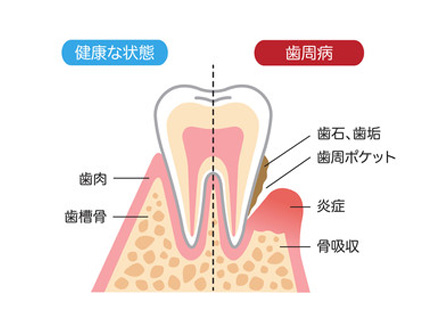 健康な歯と歯周病