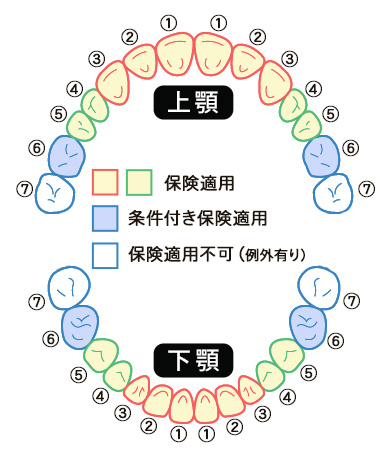 CAD/CAM冠　保険摘要歯の図