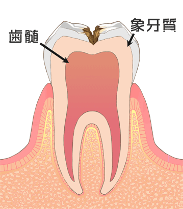 C２：歯の中（象牙質）の虫歯