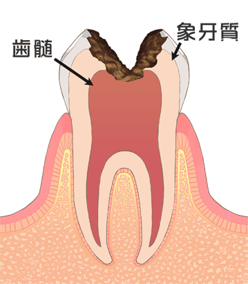 C３：神経まで達した虫歯