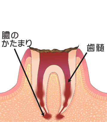 C４：歯の根まで達した虫歯