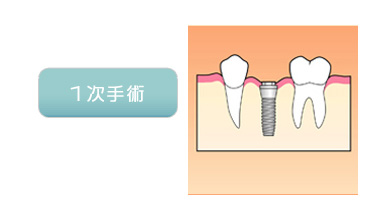 一次手術