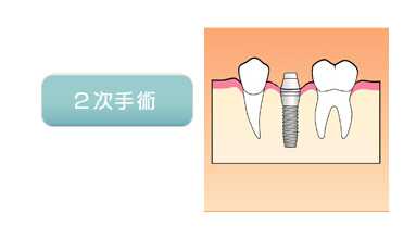 二次手術