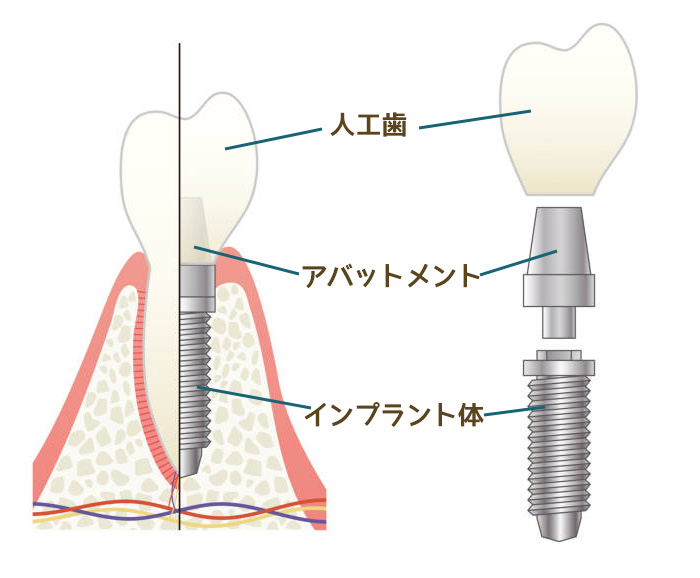 インプラント　イメージ
