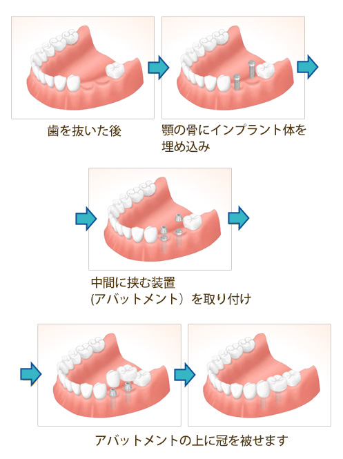 インプラント