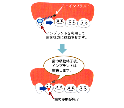 ミニインプラント矯正
